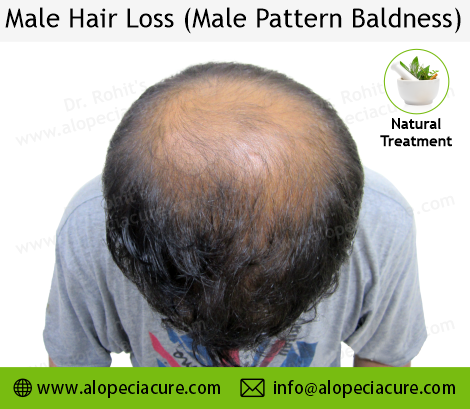 male hair loss