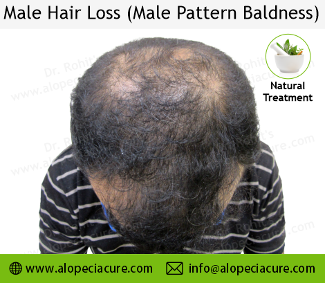 male hair loss