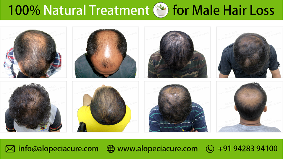 male hair loss treatment