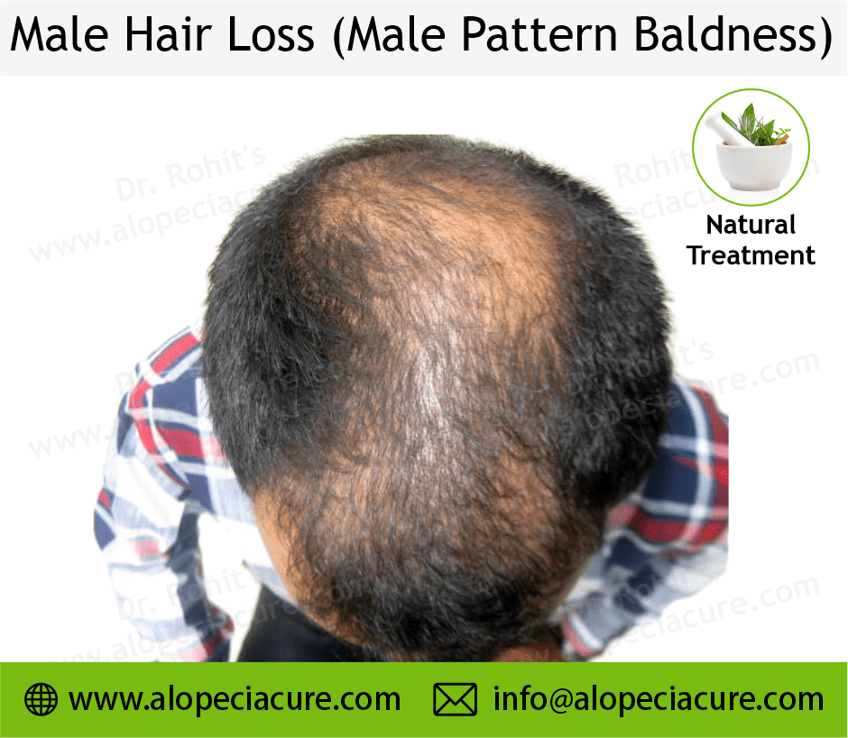 male hair loss