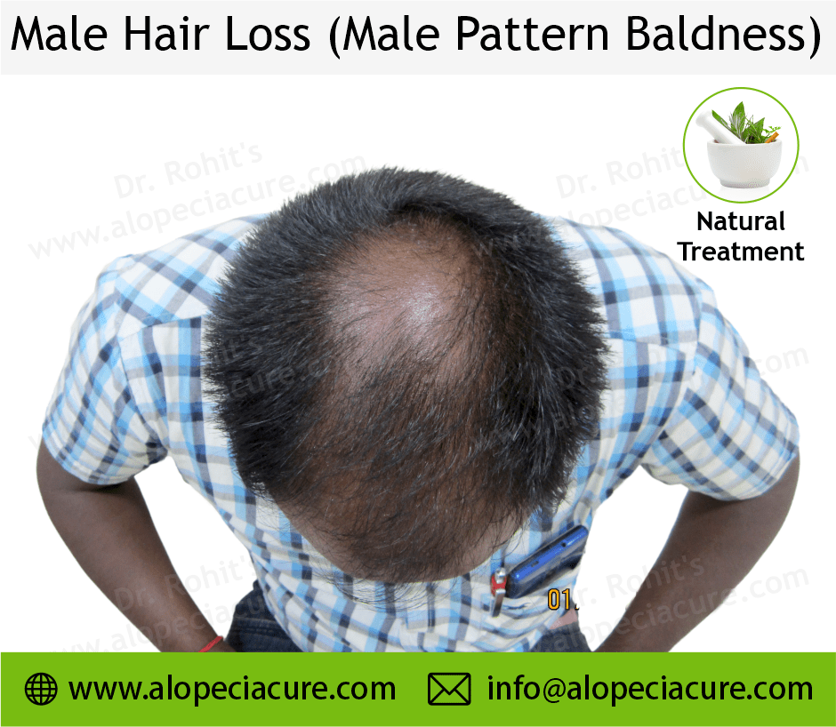 male hair loss