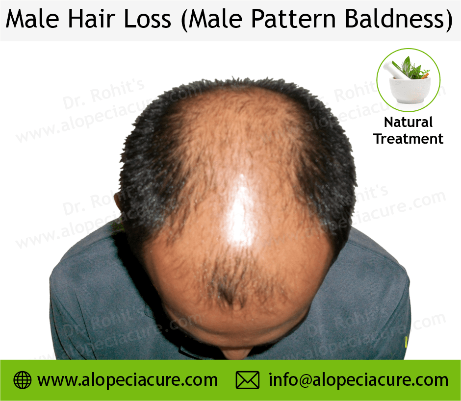 male hair loss