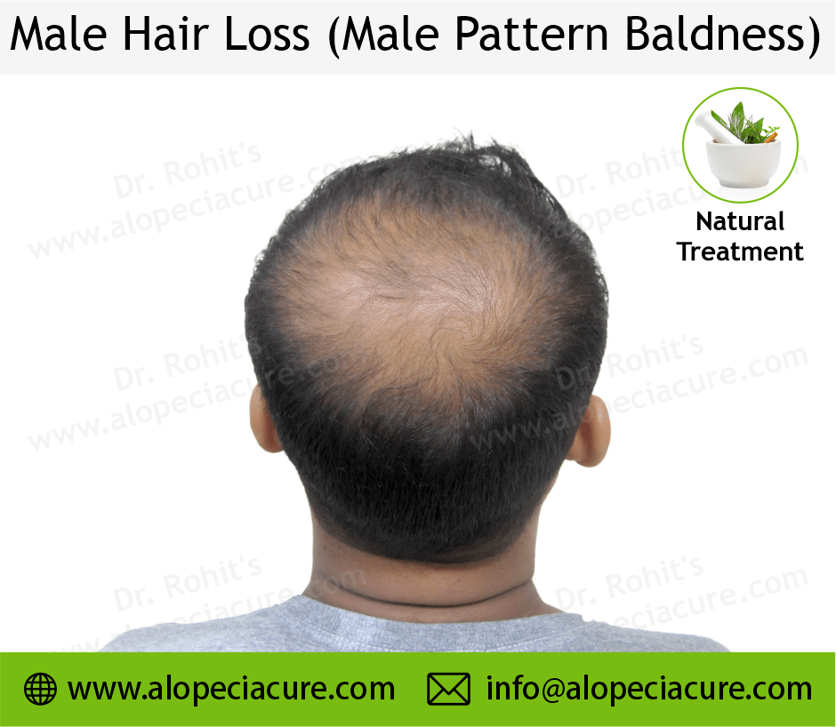 male hair loss