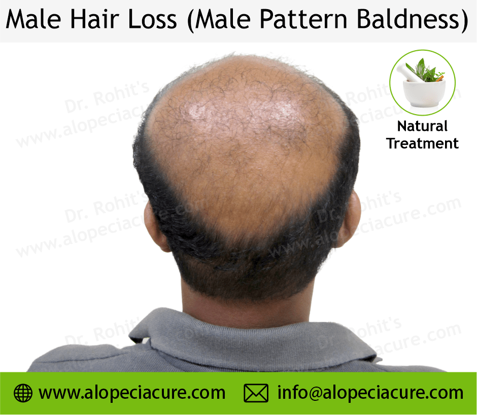 male hair loss
