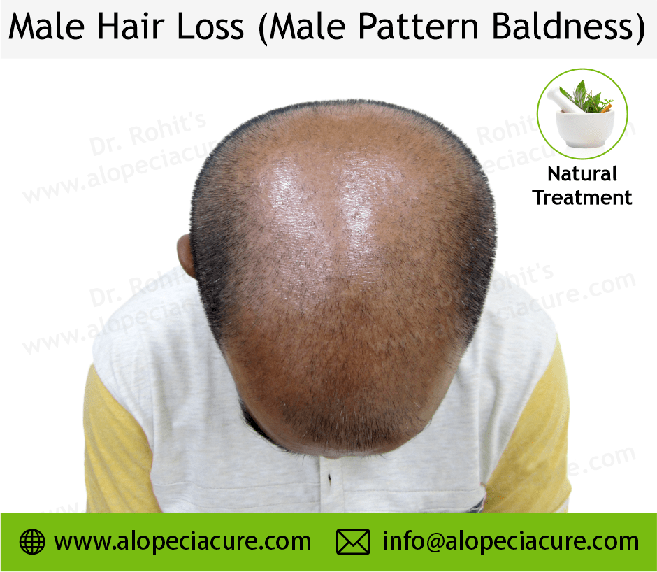 diffuse patterned alopecia