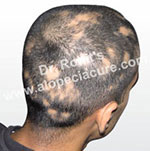 Alopecia herbal treatment in India