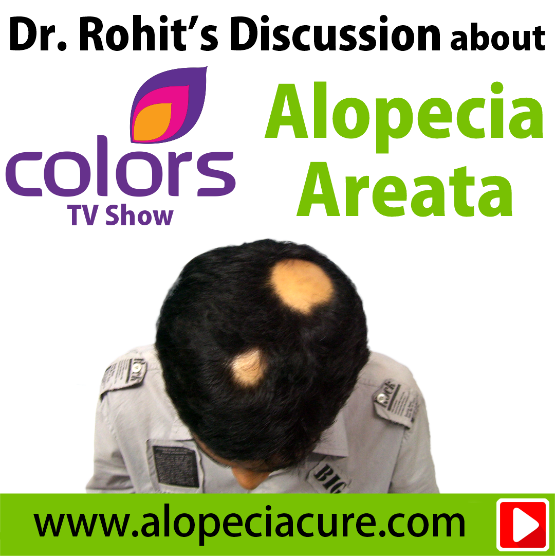 alopecia areata treatment