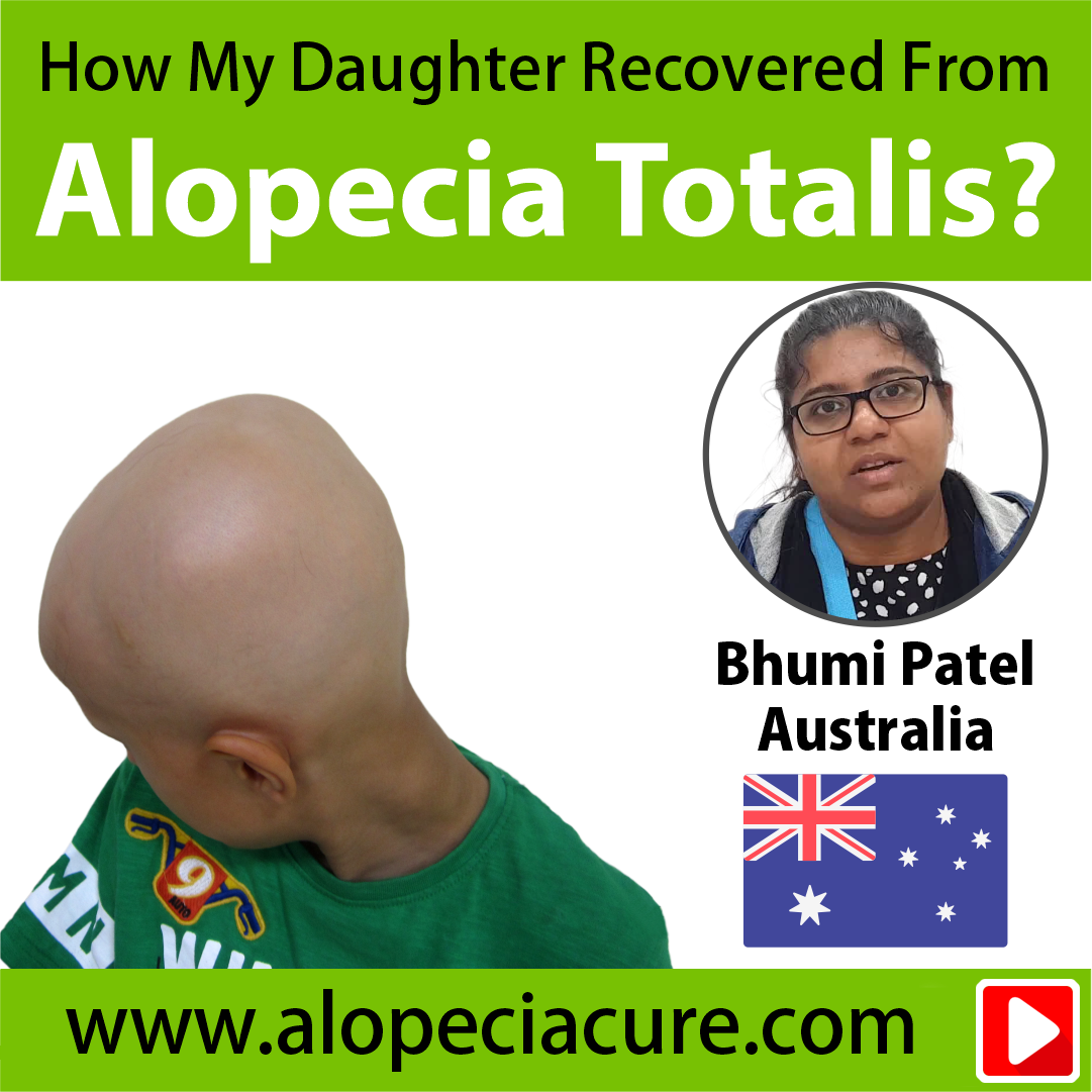 alopecia totalis treatment