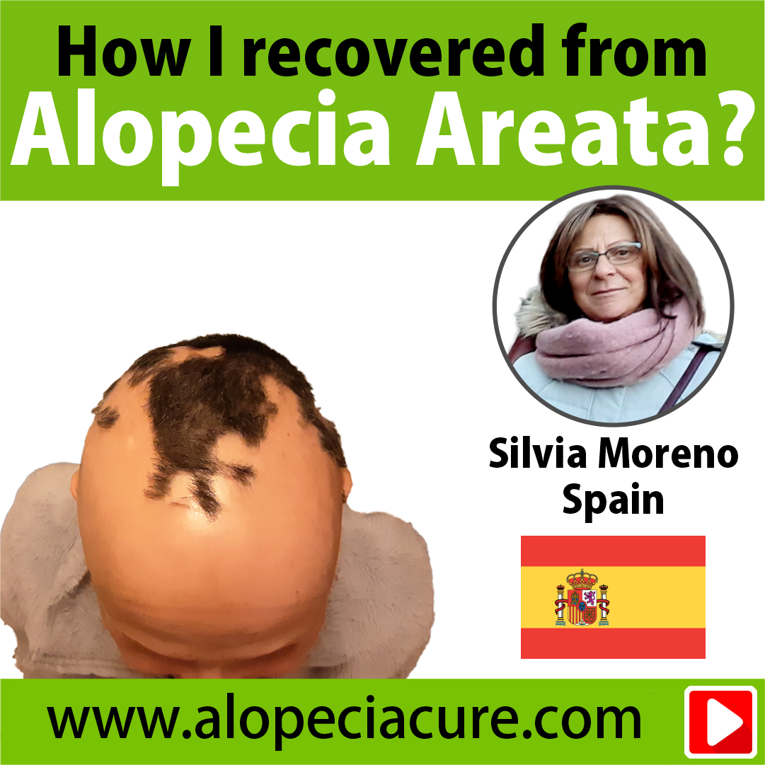 alopecia areata treatment