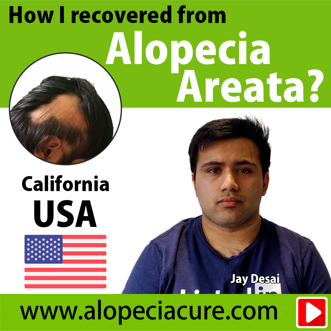 alopecia areata treatment review