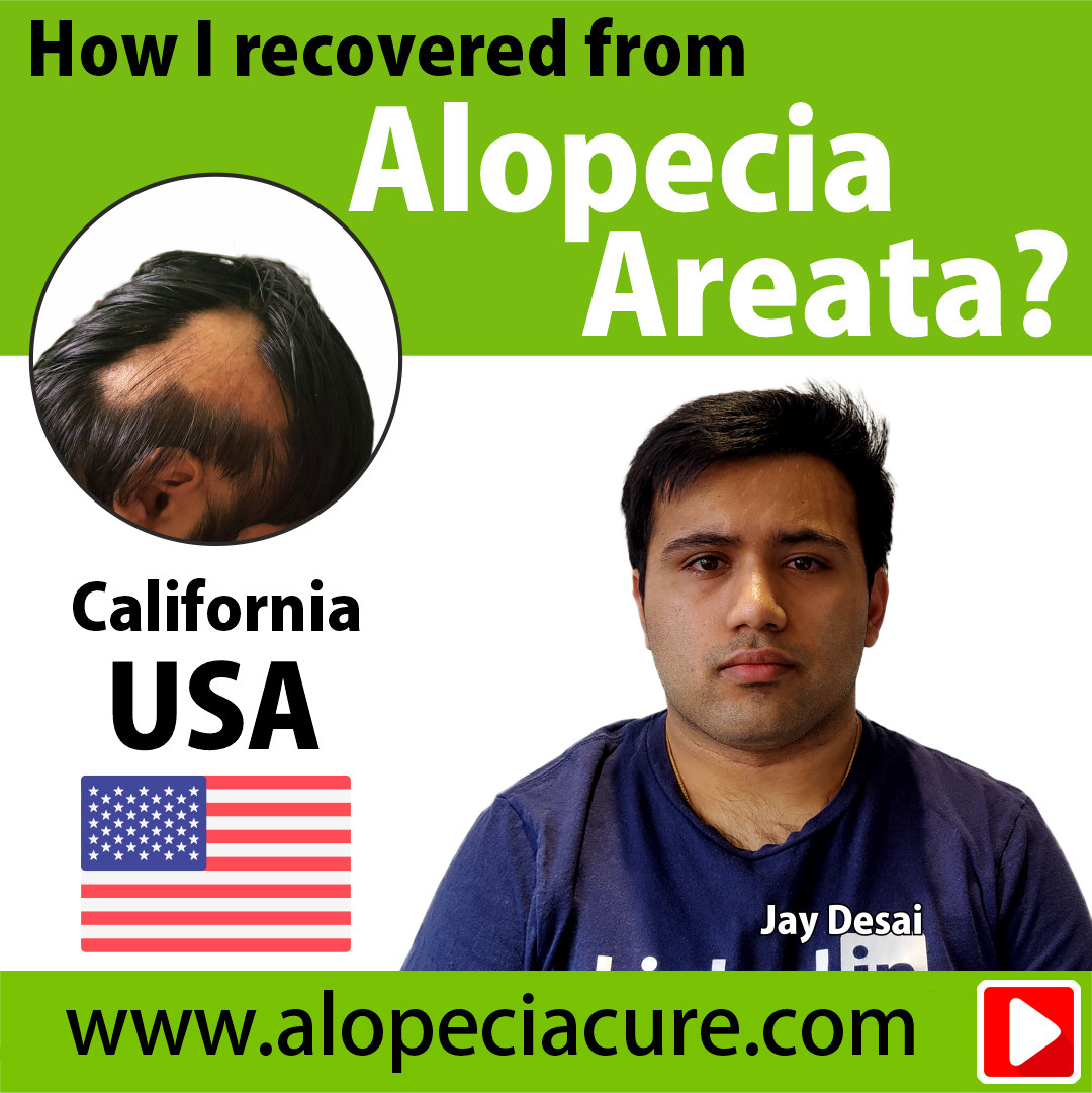 alopecia areata treatment