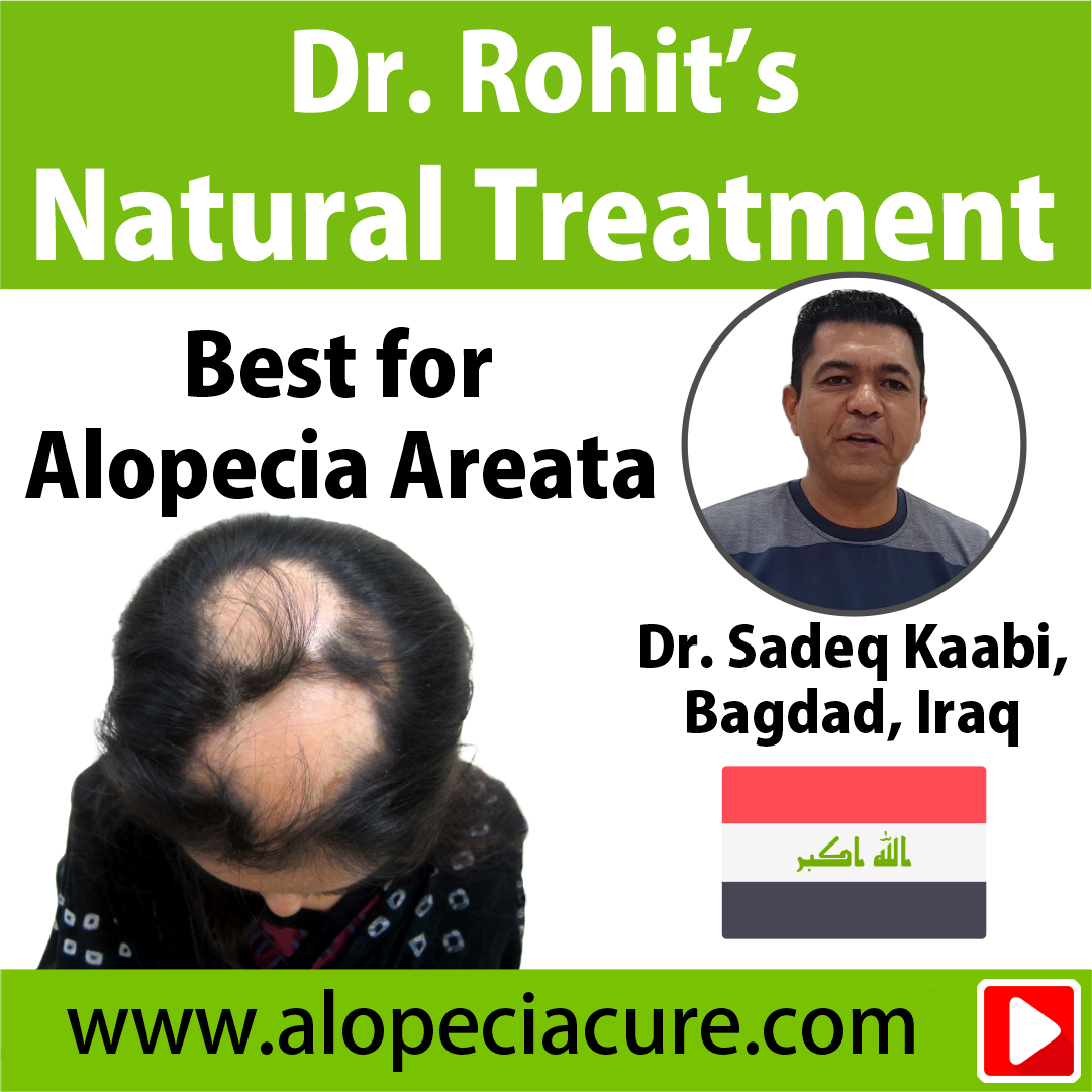 alopecia areata treatment