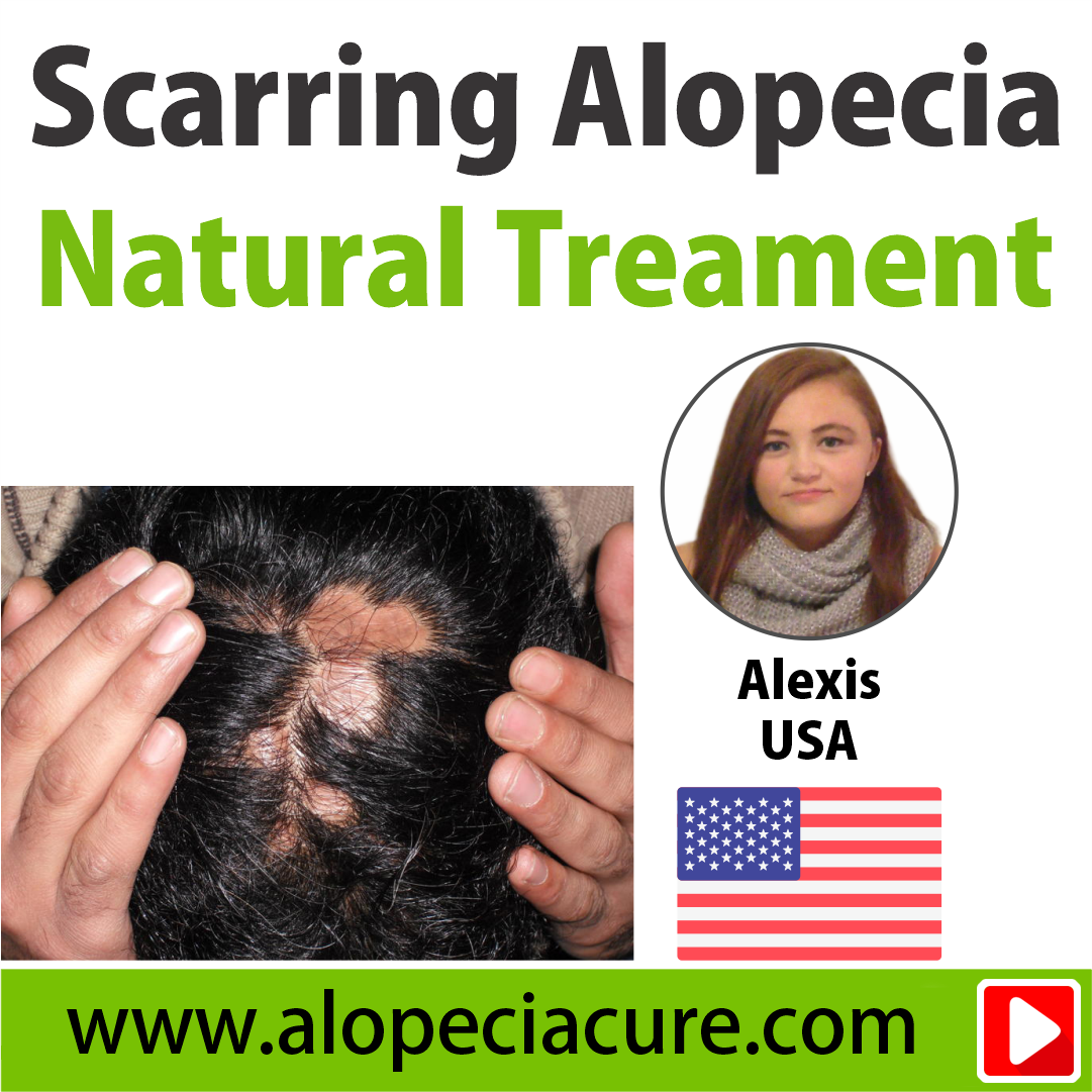scarring alopecia treatment