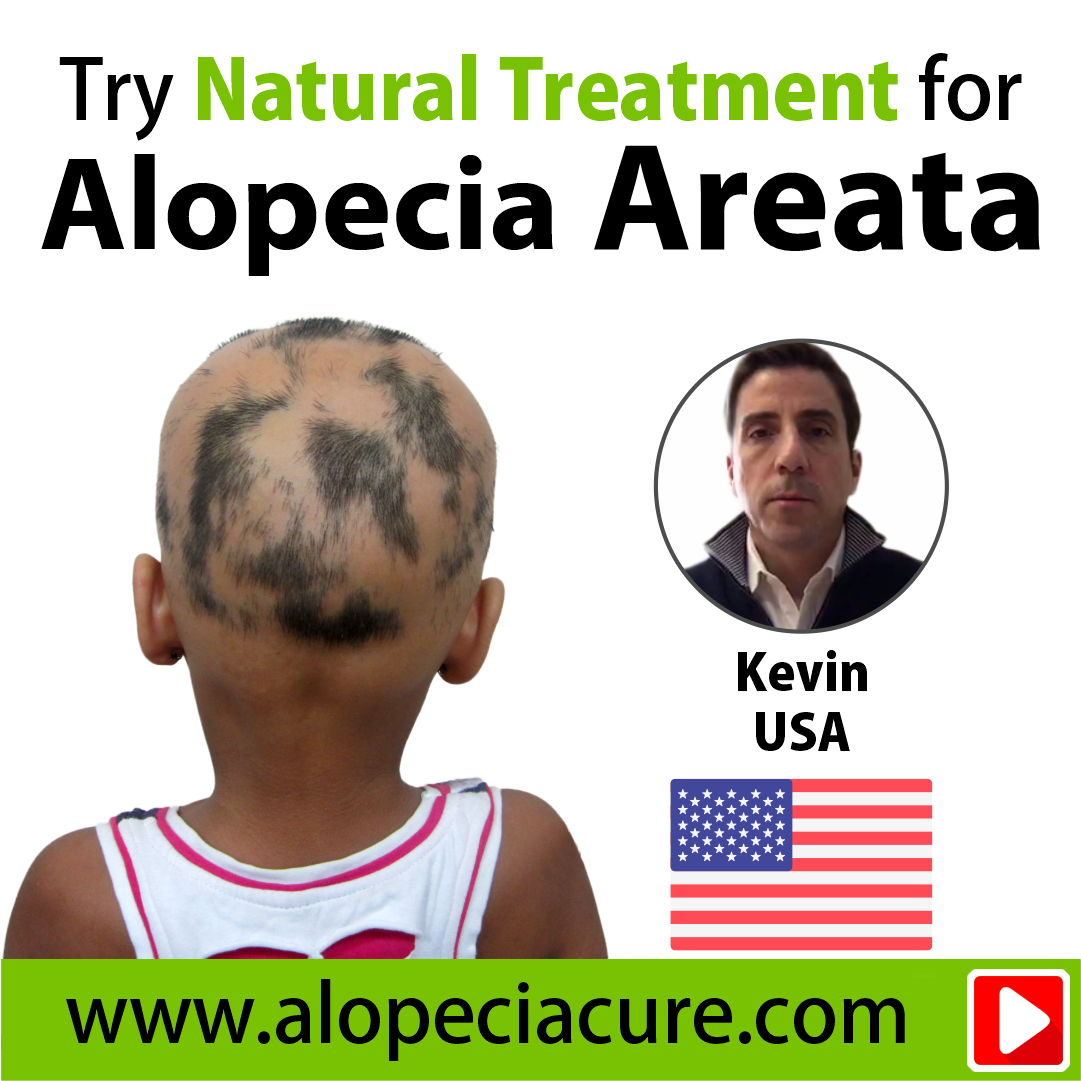 alopecia areata treatment