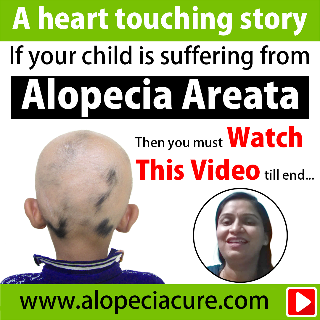 children alopecia treatment