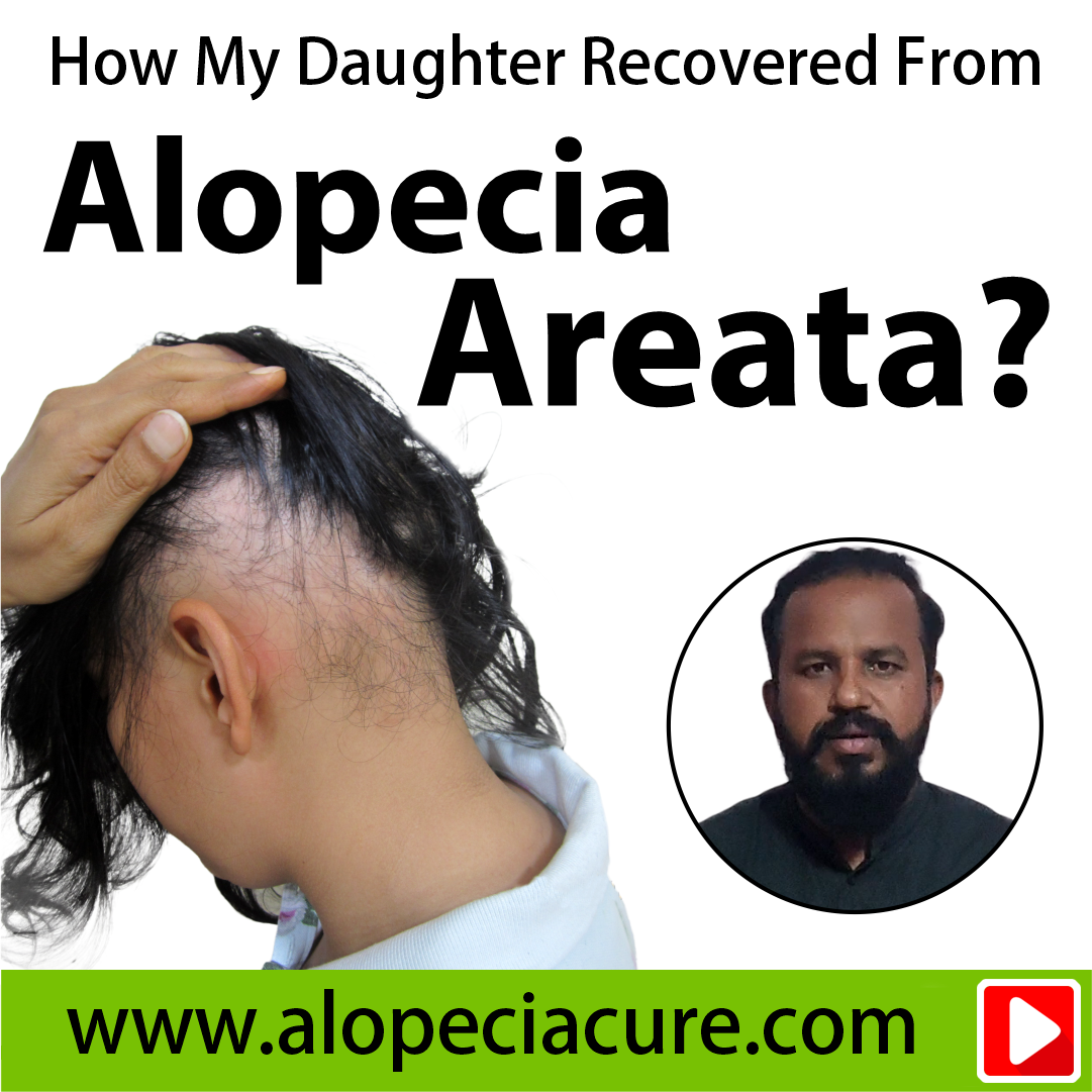 children alopecia areata treatment
