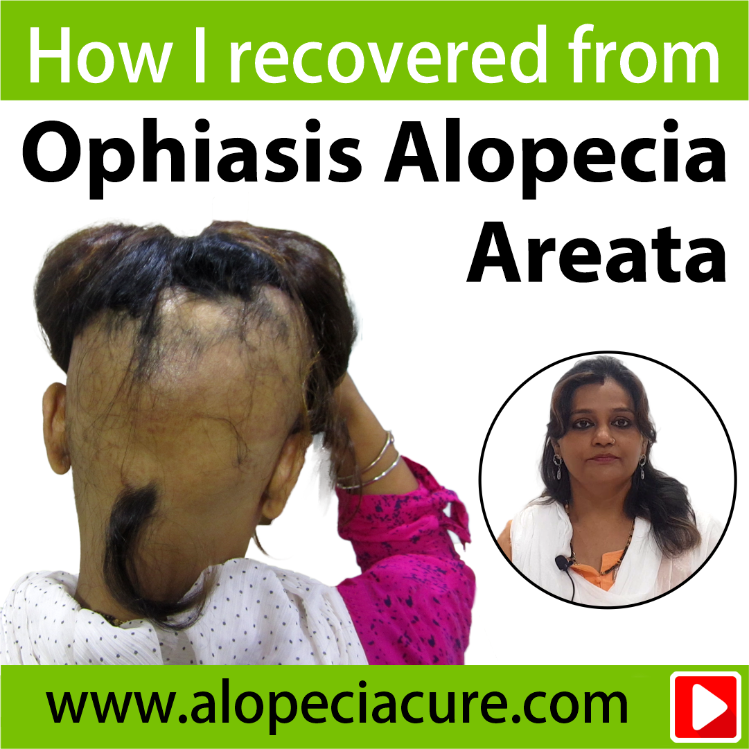 ophiasis alopecia treatment