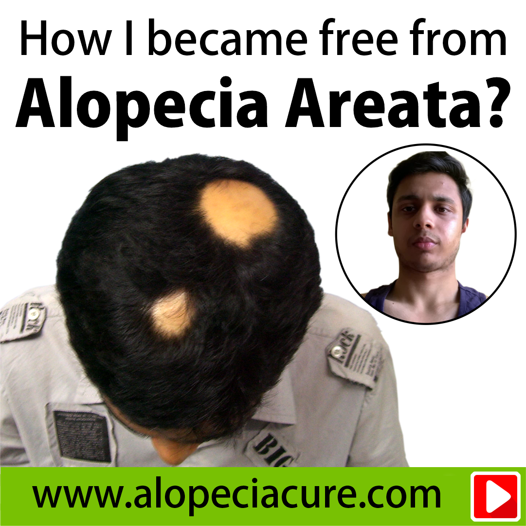 alopecia areata treatment