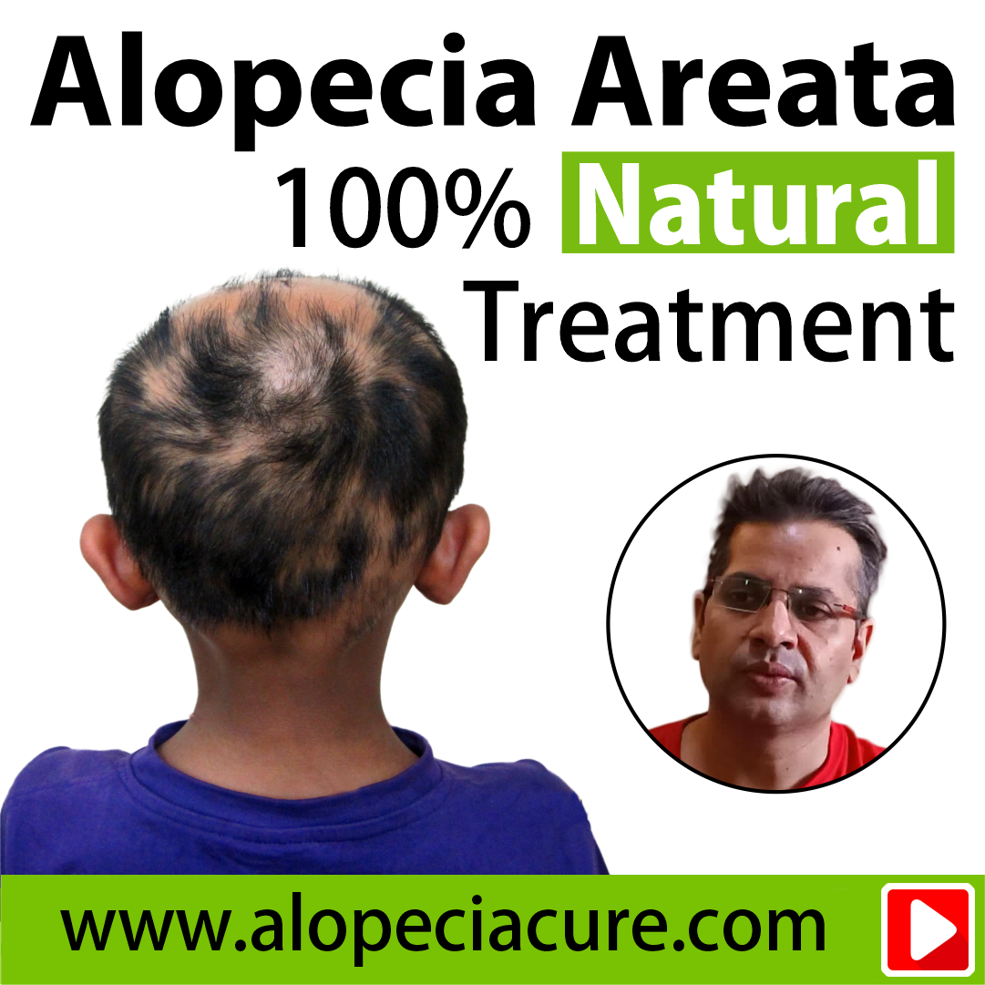 alopecia areata treatment