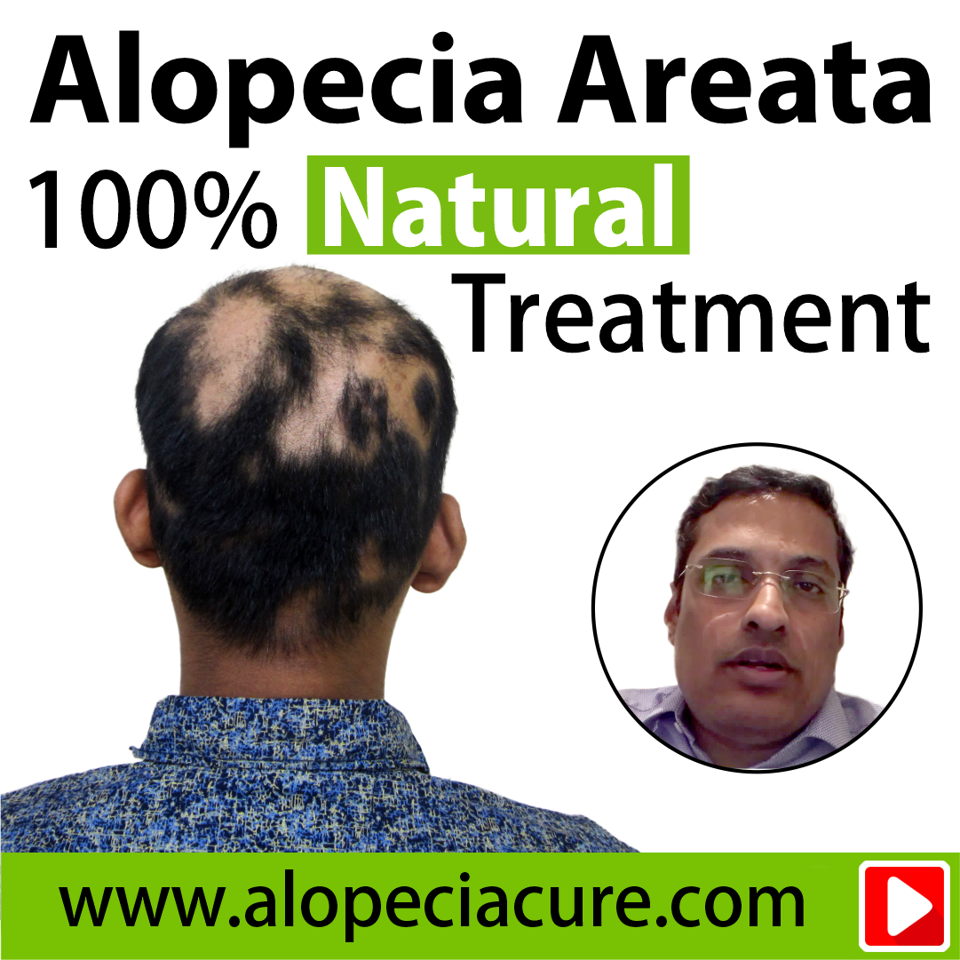 alopecia areata treatment