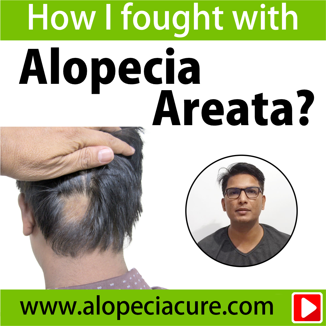 alopecia areata treatment