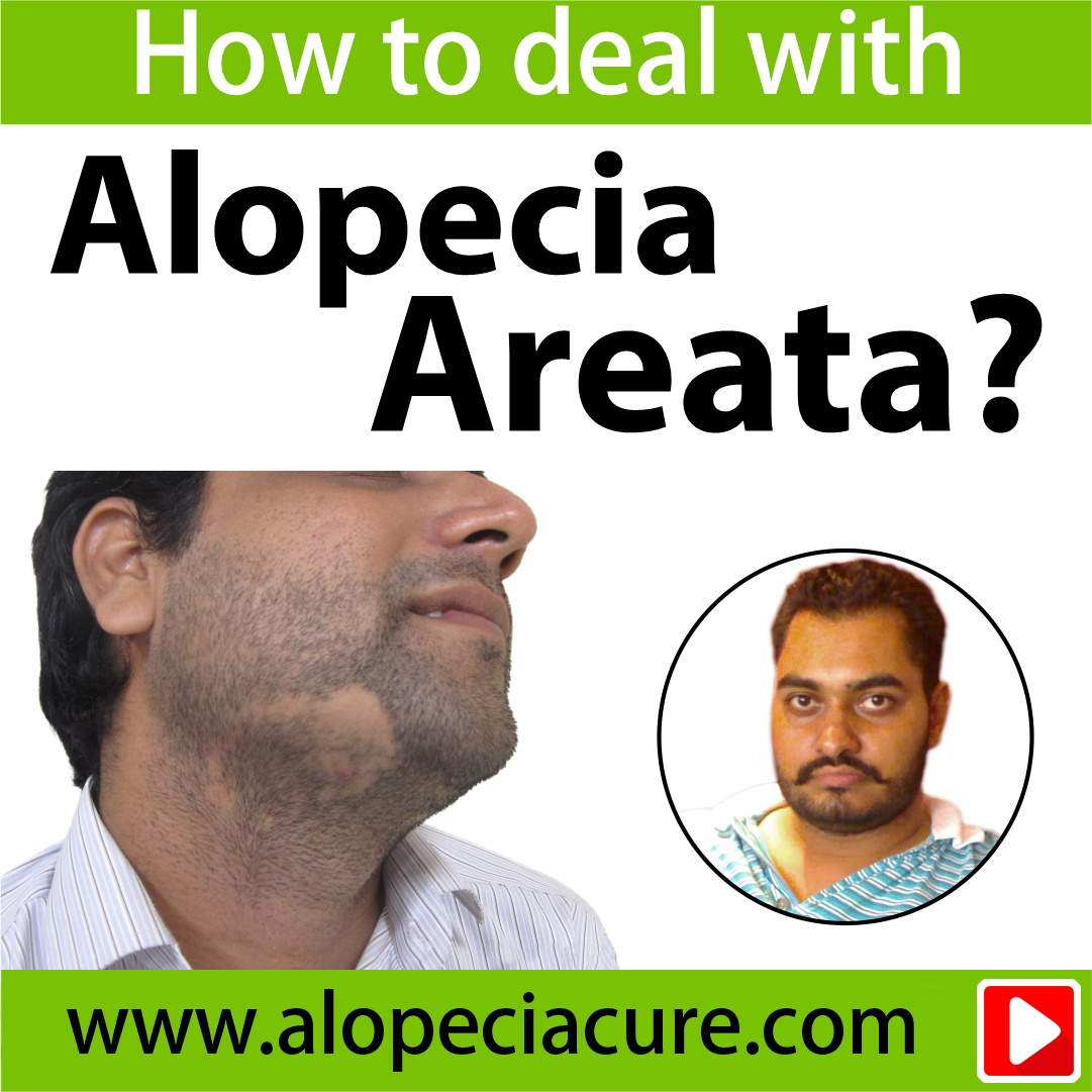 alopecia areata treatment