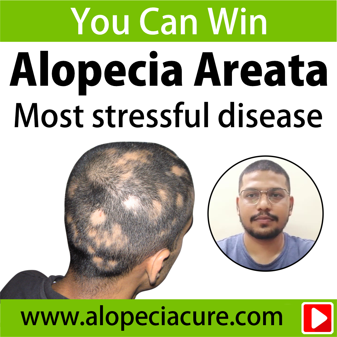 alopecia areata treatment