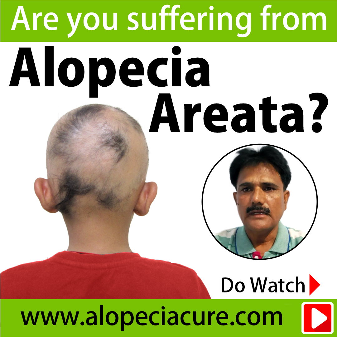 alopecia areata treatment