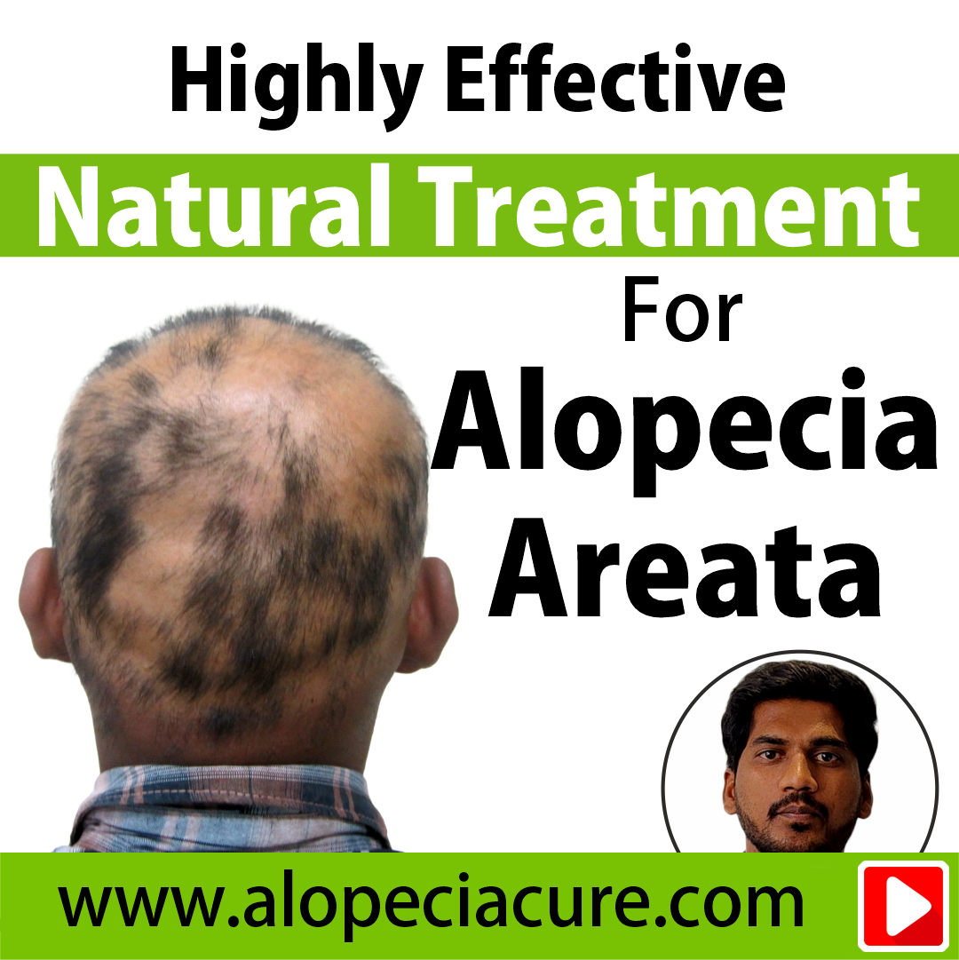 alopecia areata treatment