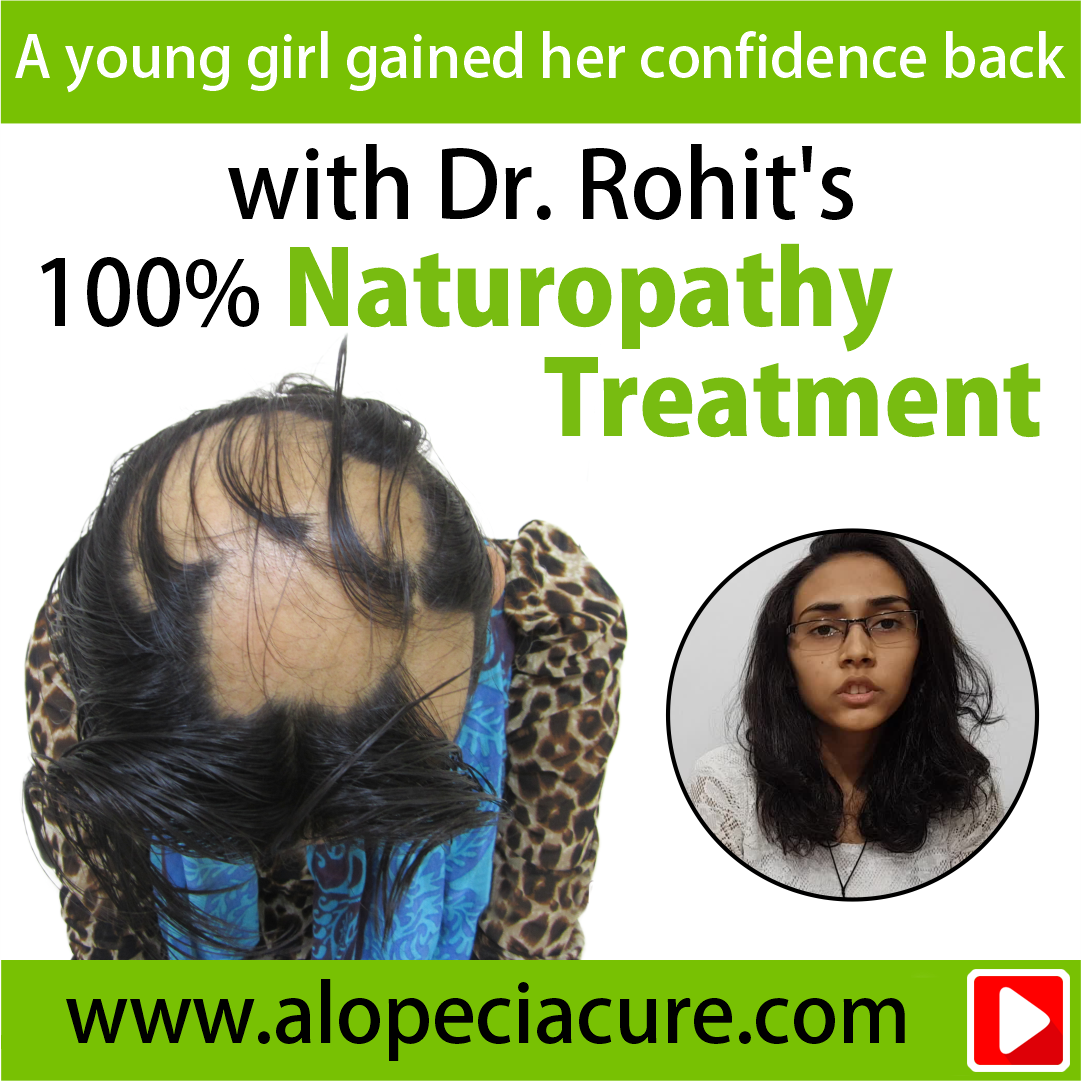 alopecia areata treatment