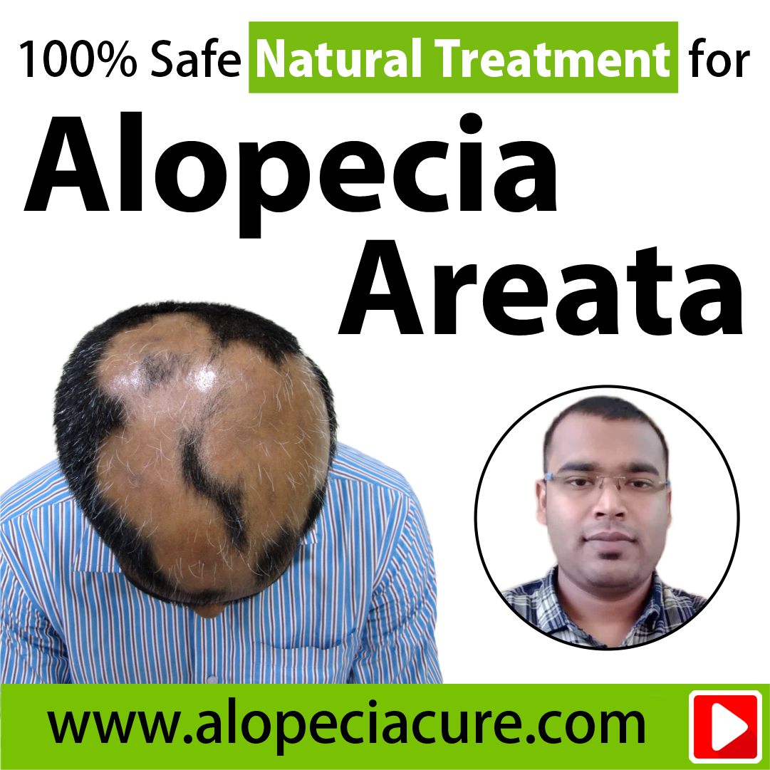 alopecia areata treatment