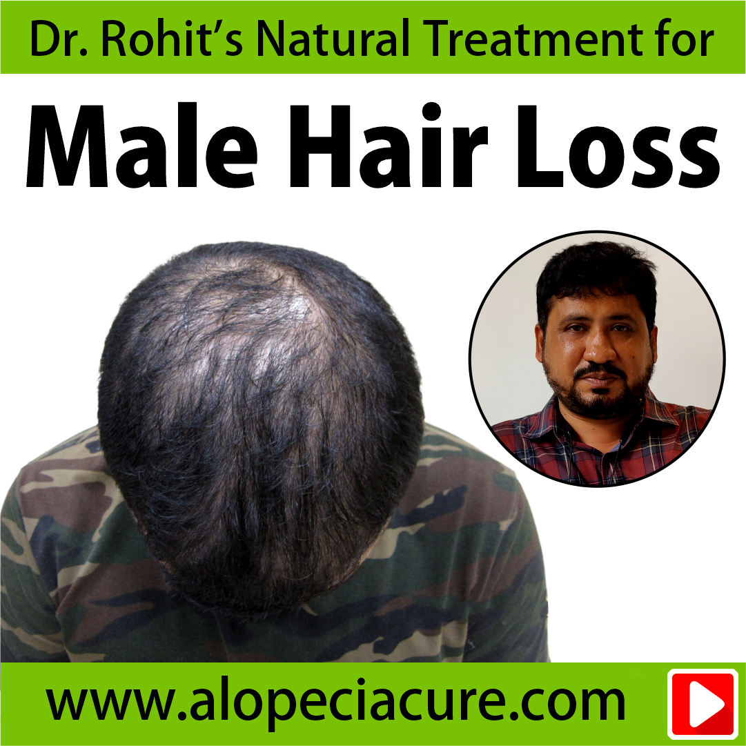 male hair loss treatment