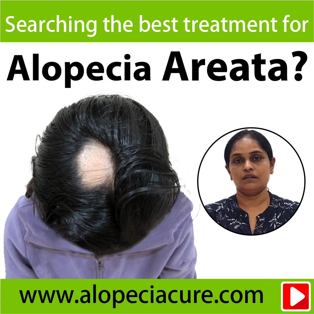 alopecia areata treatment