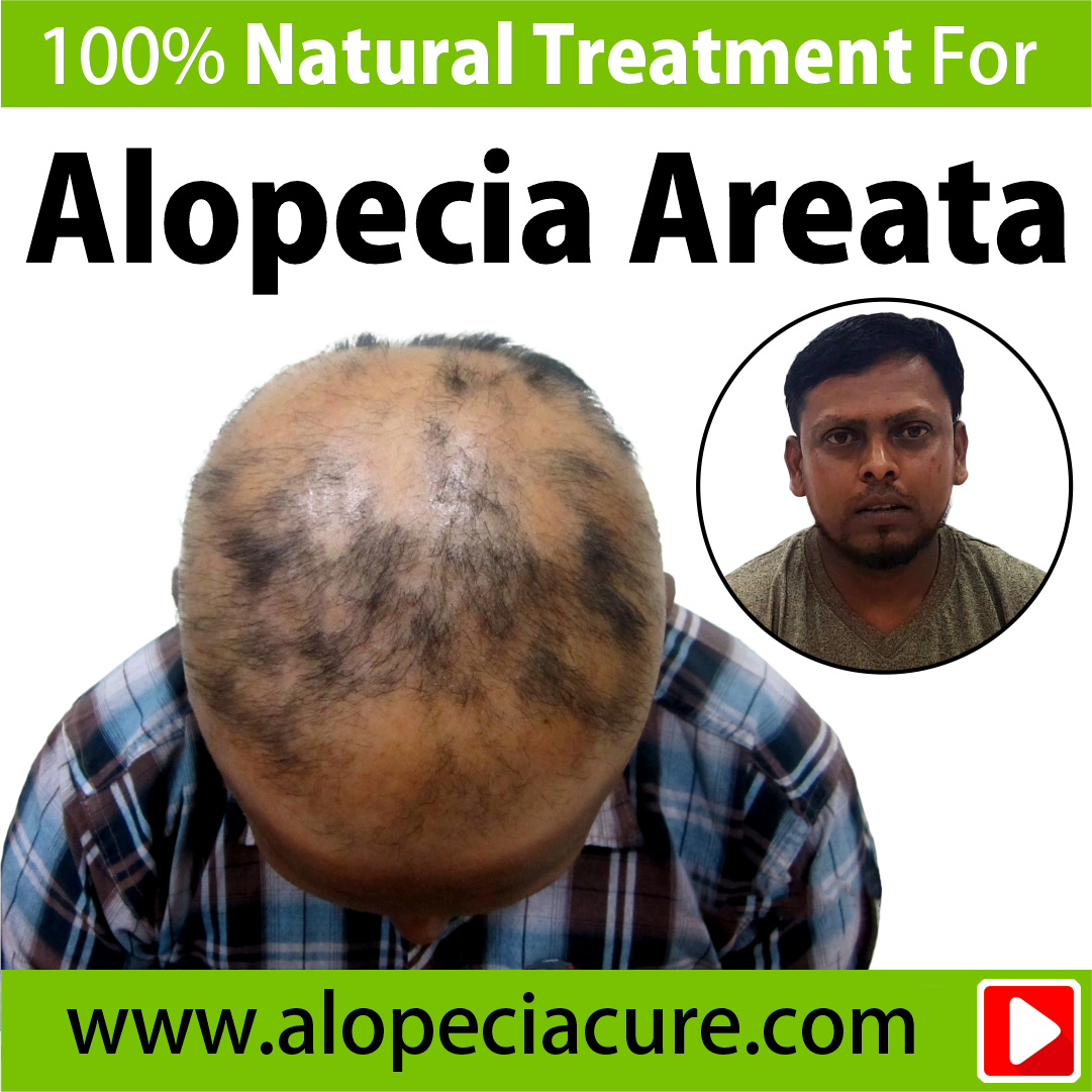 alopecia treatment