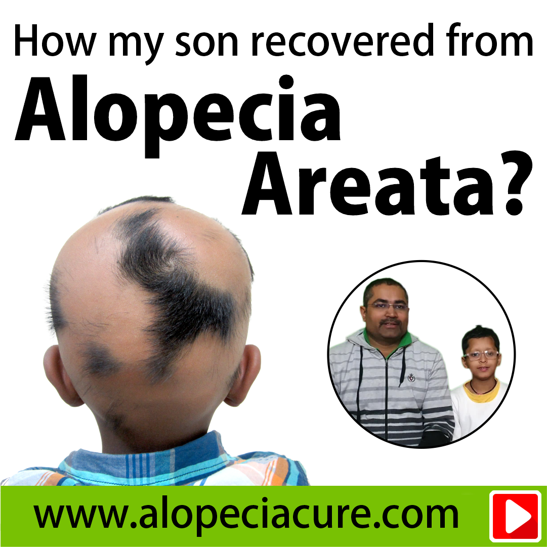 alopecia treatment