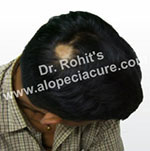 Primary alopecia natural treatment