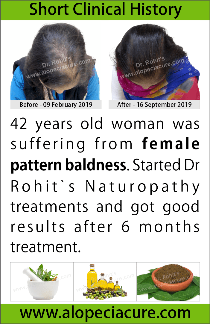 female hair loss treatment