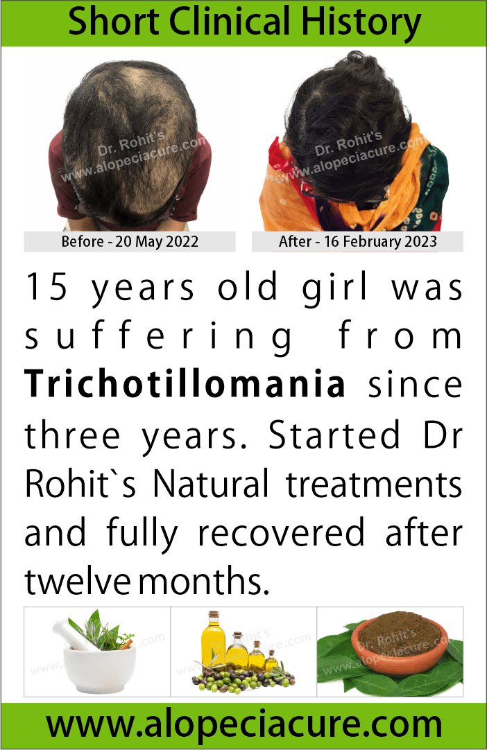 trichotillomania treatment