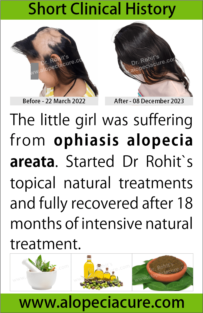 ophiasis alopecia areata treatment