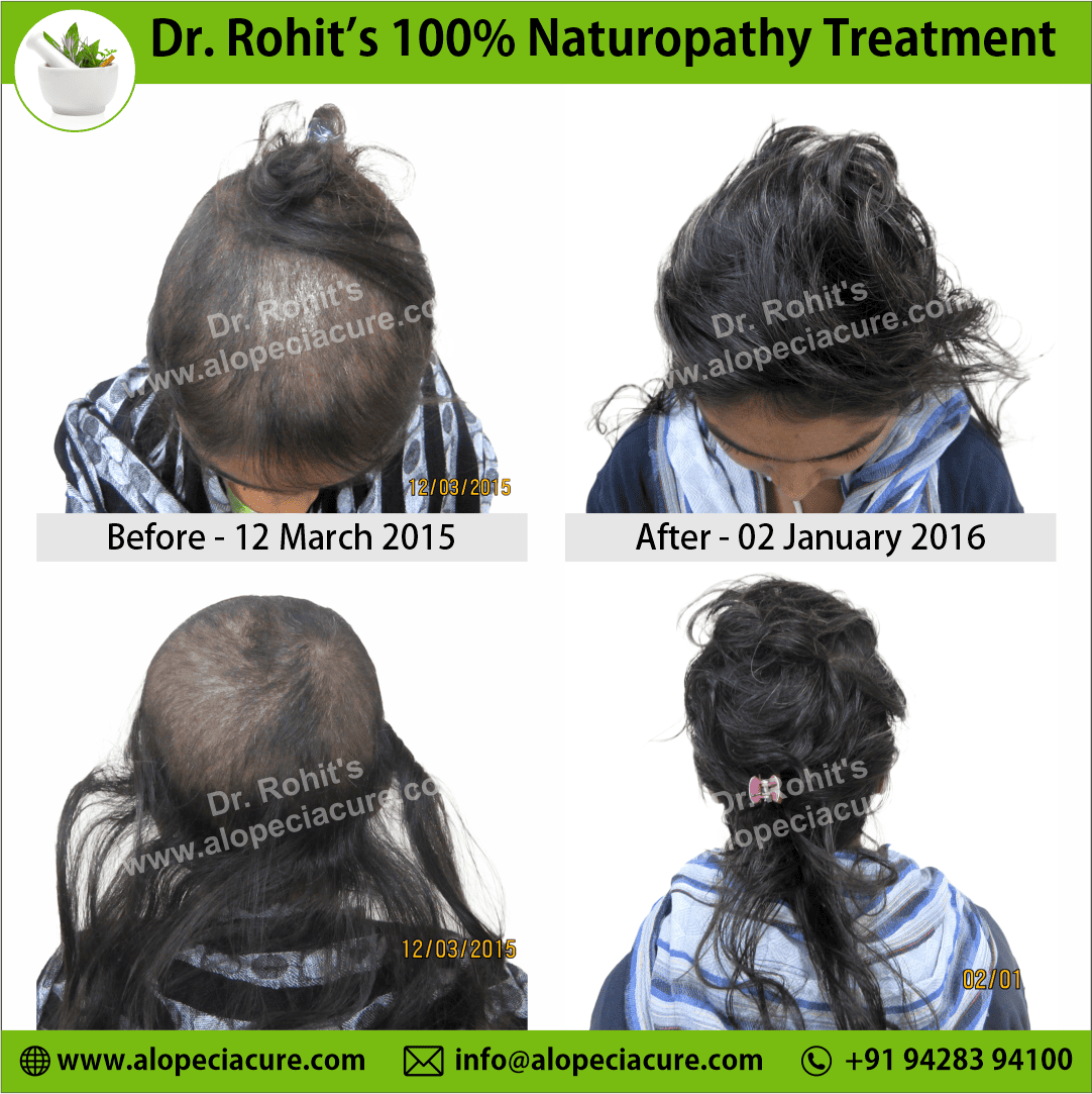 trichotillomania treatment