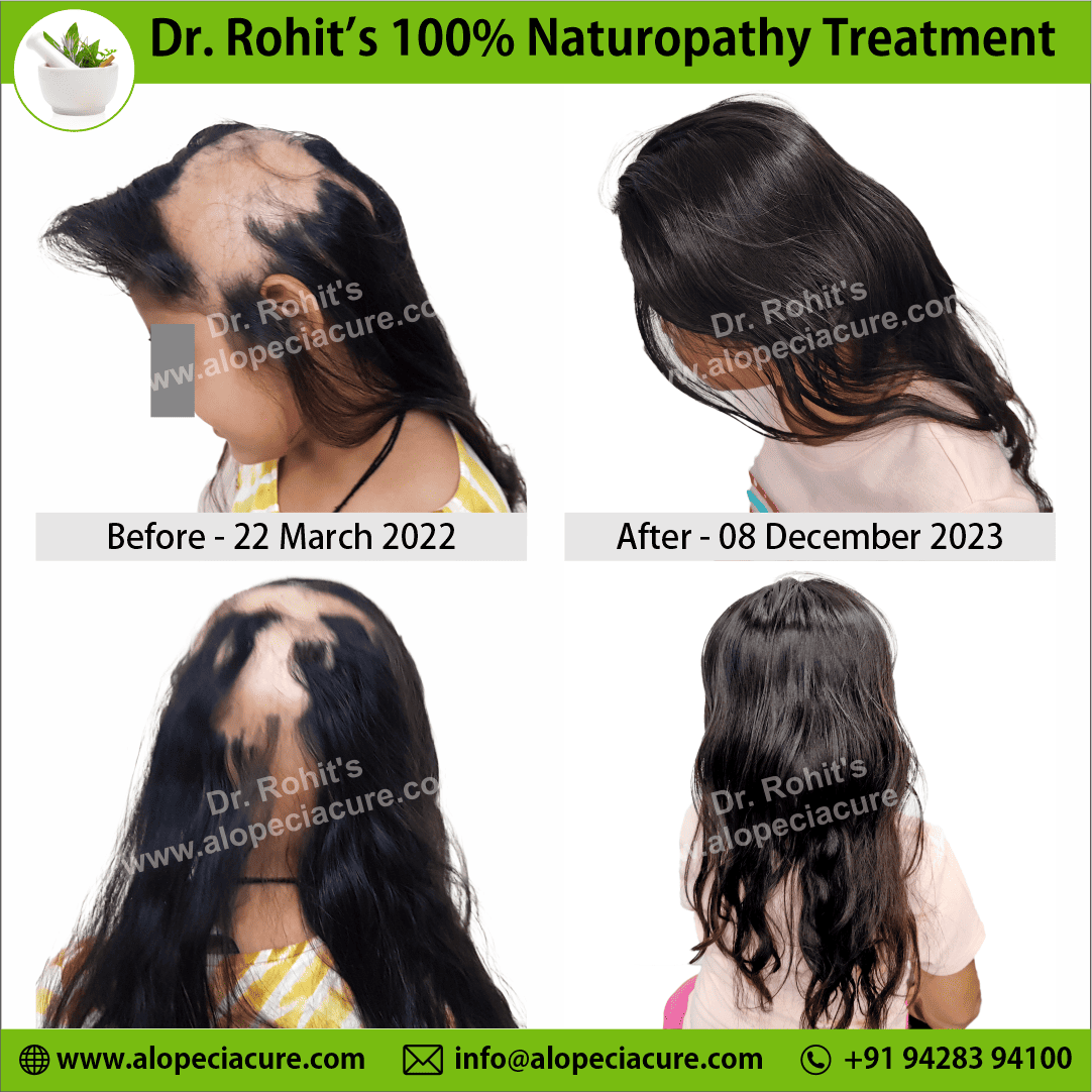 ophiasis alopecia areata treatment