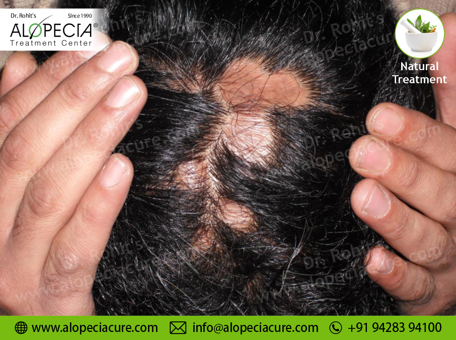 Scarring Alopecia