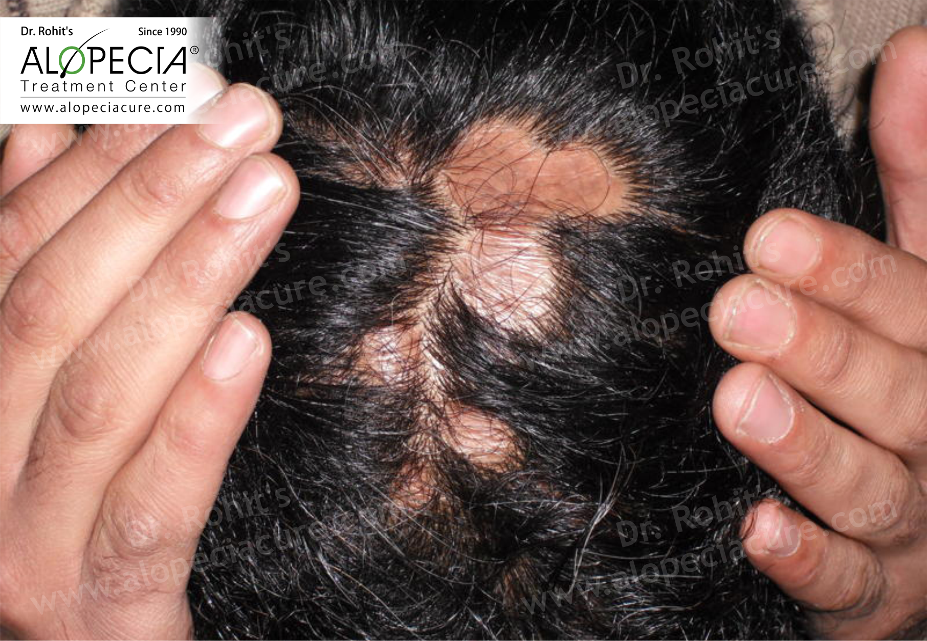 Alopecia: What It Is, Causes, Signs, and Treatment | Osmosis