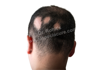 Various types of alopecia or hair loss. Try Dr Rohit's 100% Natural  Treatments.