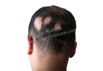 Scarring Alopecia