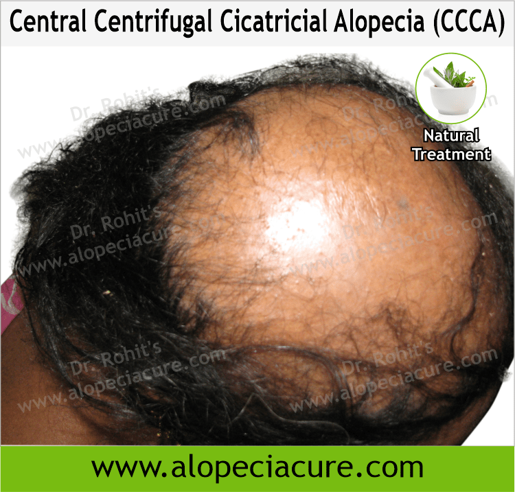 Central Centrifugal Cicatricial Alopecia (CCCA)