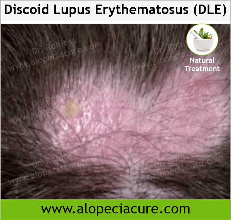 Discoid Lupus Erythematosus (DLE)