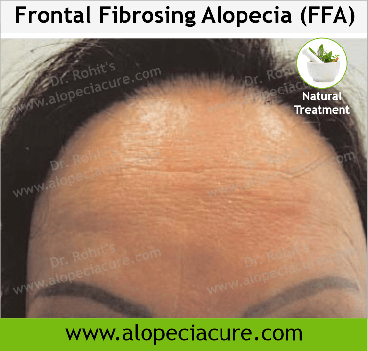 Frontal Fibrosing Alopecia (FFA)