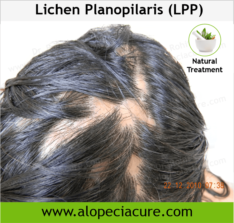 Lichen Planopilaris (LPP)