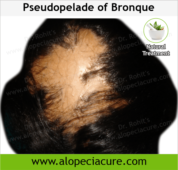 Pseudopelade of Bronque